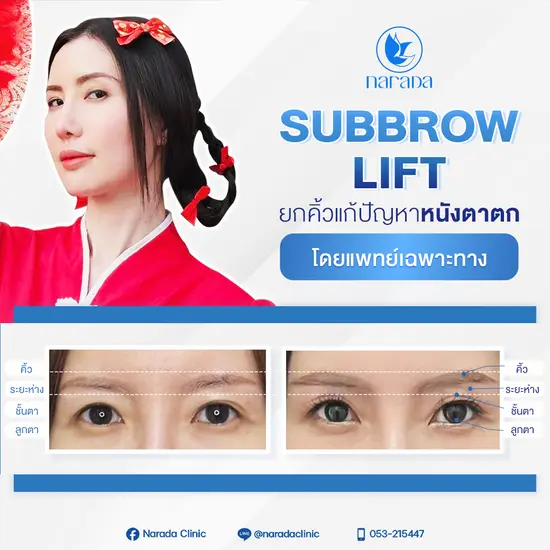 การผ่าตัดยกคิ้ว SubBrowLift