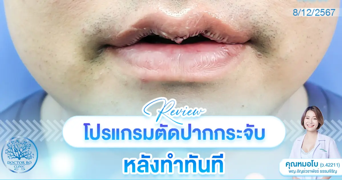 รีวิวปากกระจับ หมอโบ เชียงใหม่ สวยเป๊ะ ปลอดภัยแน่นอน