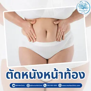 ตัดหนังหน้าท้อง (Tummy Tuck) ยกกระชับหน้าท้องเพื่อหุ่นสวย