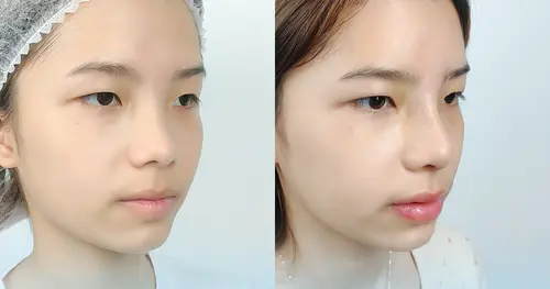 รีวิวเสริมจมูก เชียงใหม่กับหมอโบ เทคนิคใหม่ ปลอดภัยสูง