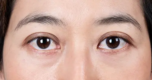 ทำตาสองชั้นคืออะไร ทำไมถึงได้รับความนิยมในเชียงใหม่
