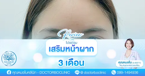 รีวิวเสริมหน้าผาก ก่อน–หลัง พร้อมข้อควรรู้ก่อนตัดสินใจ