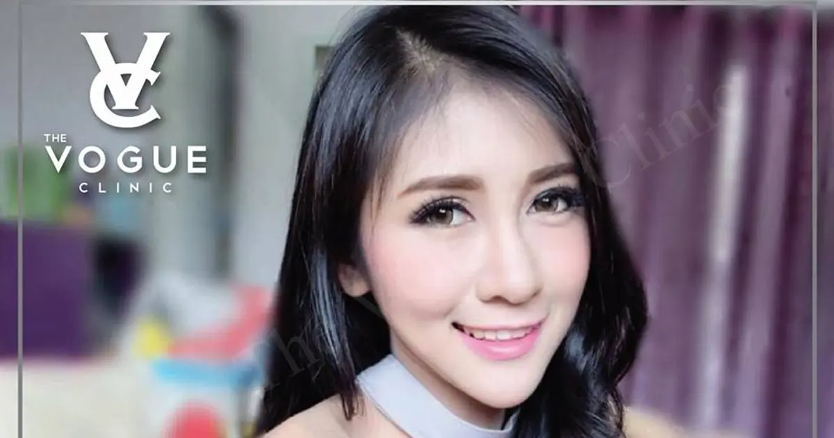 เสริมคาง หน้าเรียว