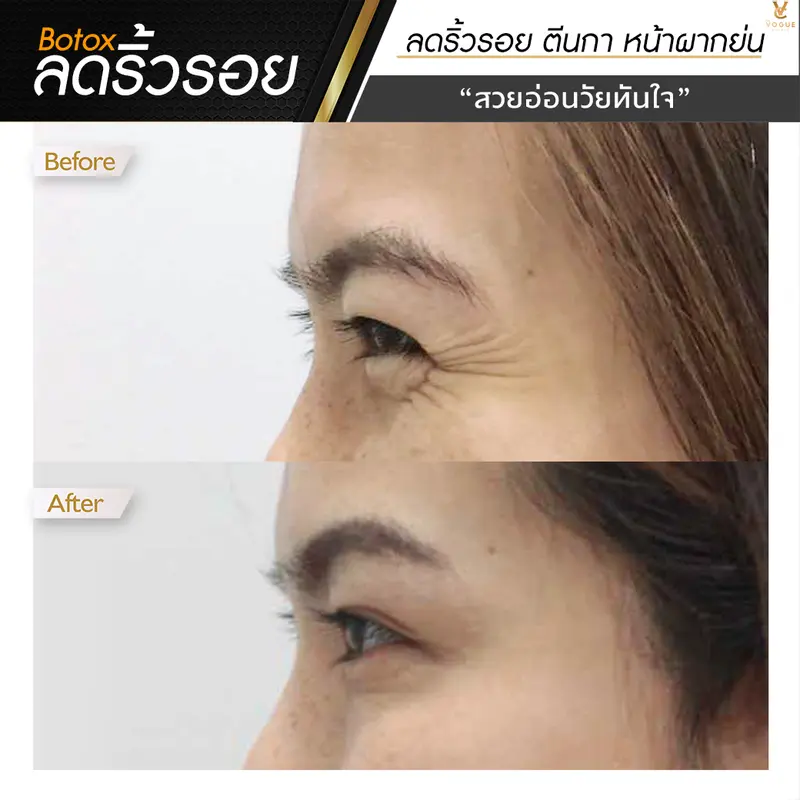 Botox