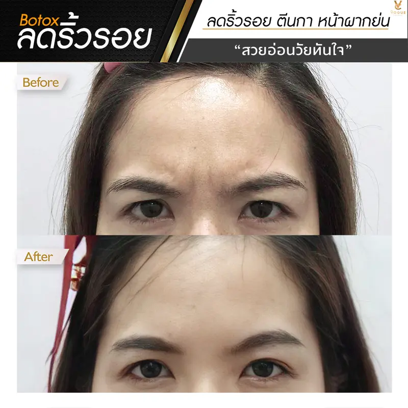 Botox