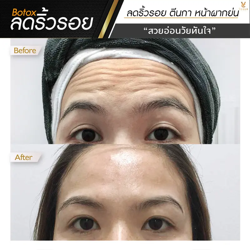 Botox