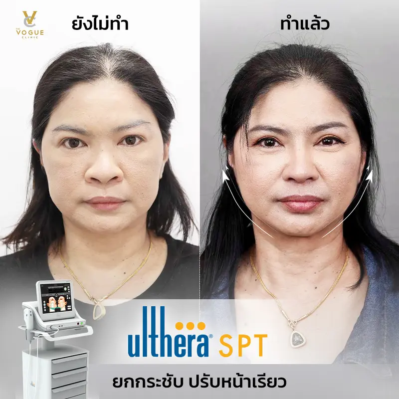 Ultherra SPT
