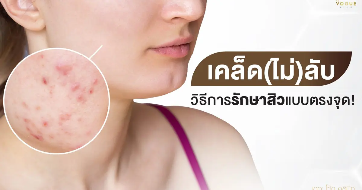 เคล็ด(ไม่)ลับ วิธีการรักษาสิวแบบตรงจุด!