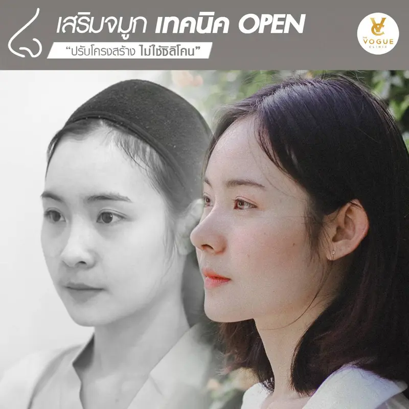 เสริมจมูกopen ชลบุรี