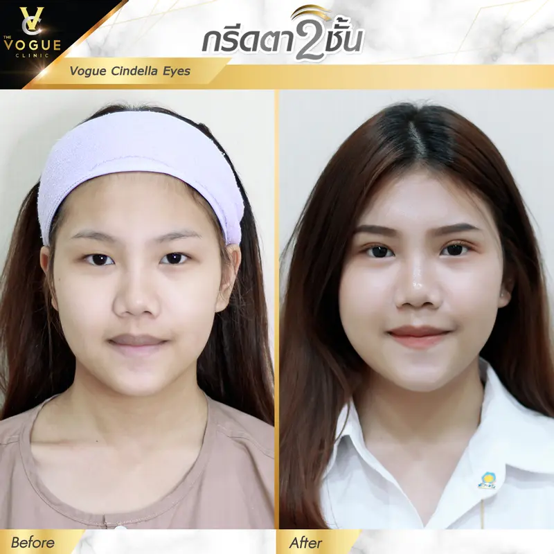 ตาสองชั้้น ชลบุรี
