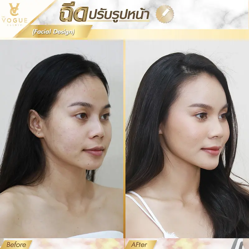 Filler ชลบุรี