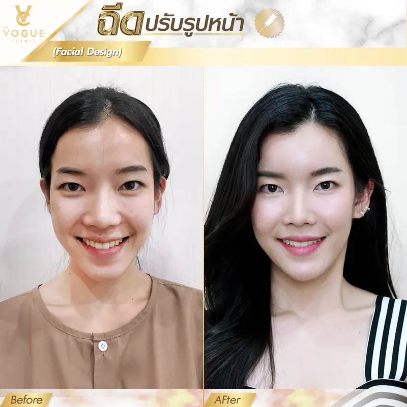 ฉีดฟิลเลอร์ ชลบุรี