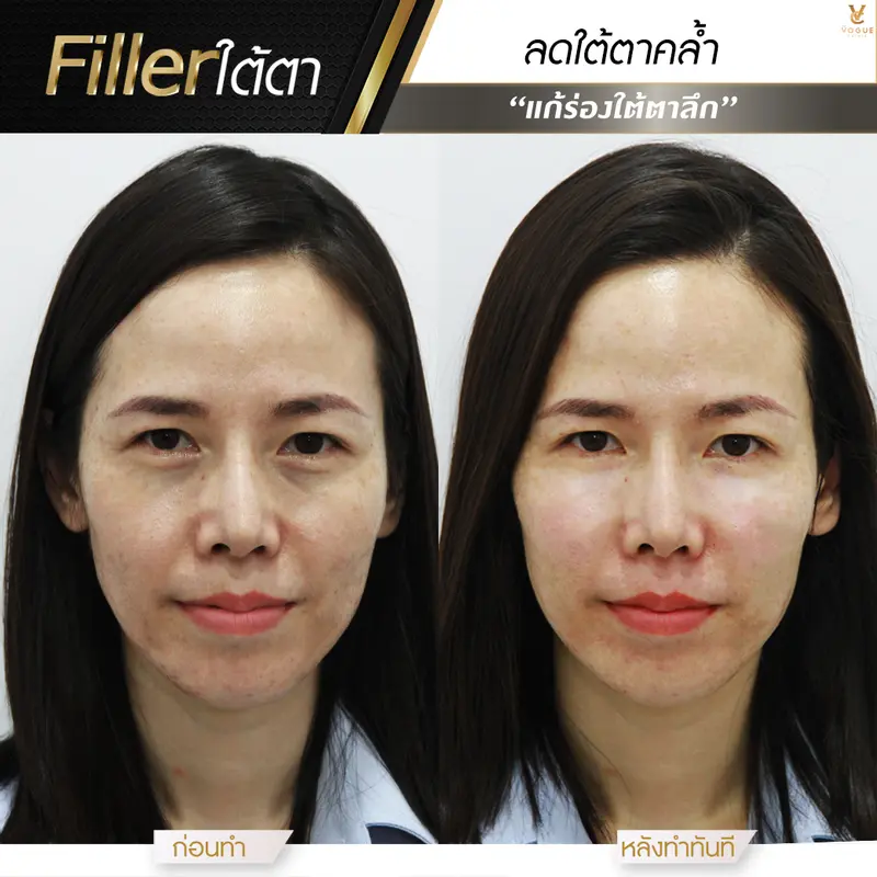 ฟิลเลอร์ปรับรูปหน้า
