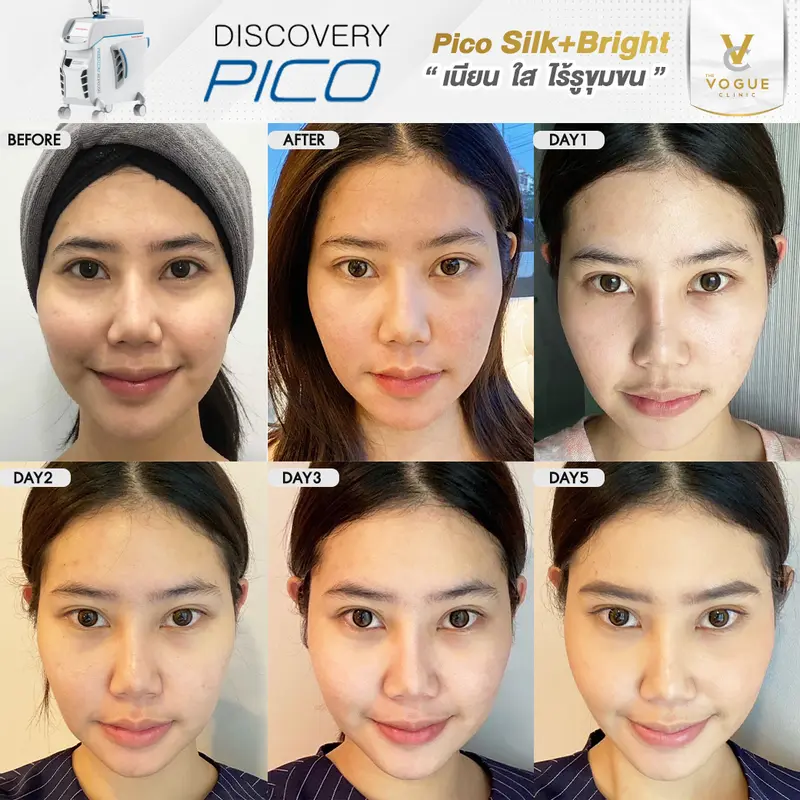 Pico Laser ชลบุรี