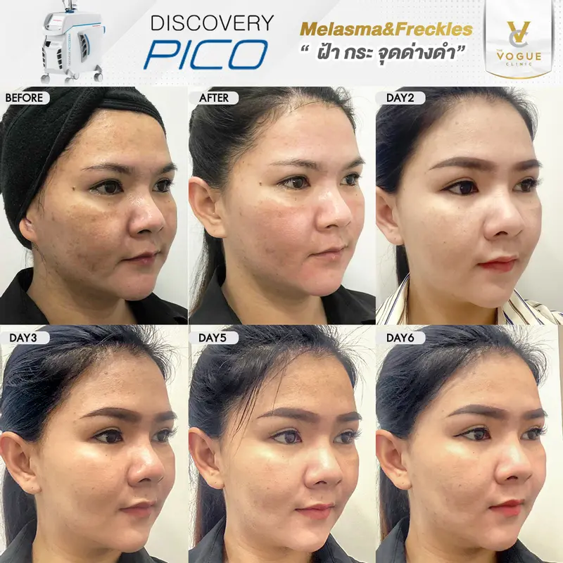 รักษาฝ้า pico laser
