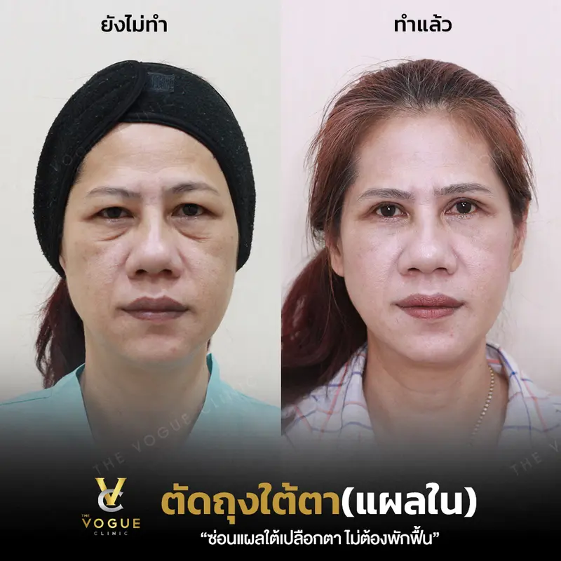 ตัดถุงใต้ตา