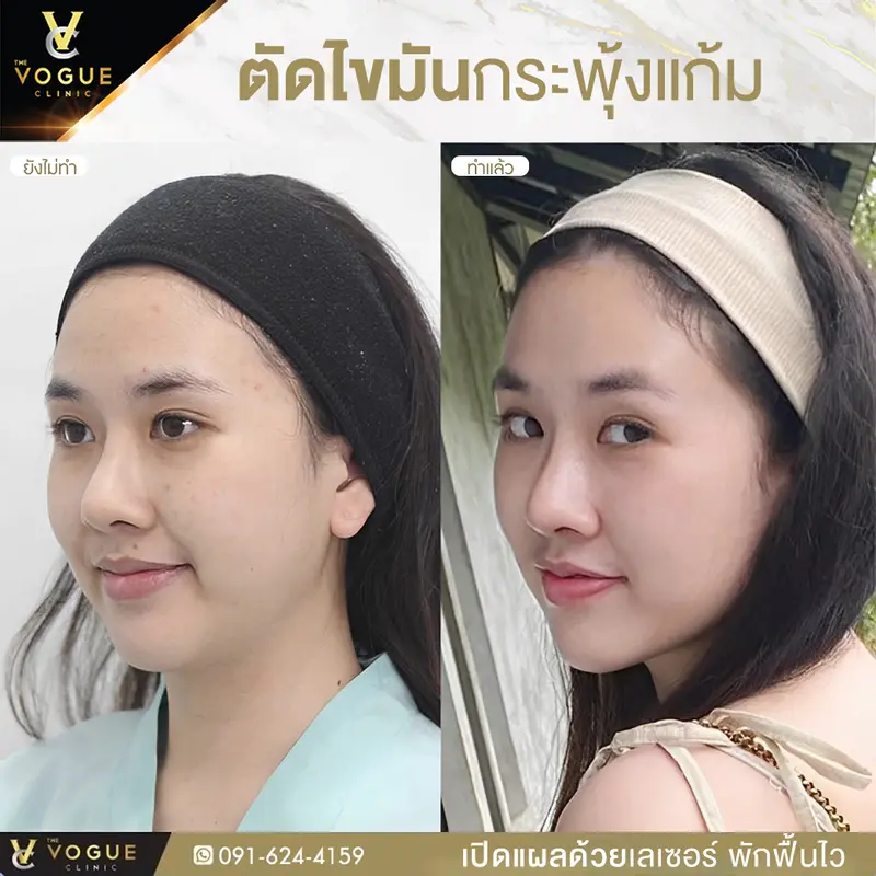 ตัดไขมันกระพุ้งแก้ม