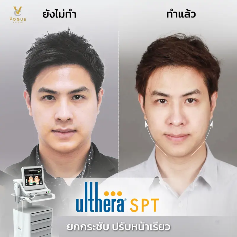 Ulthera