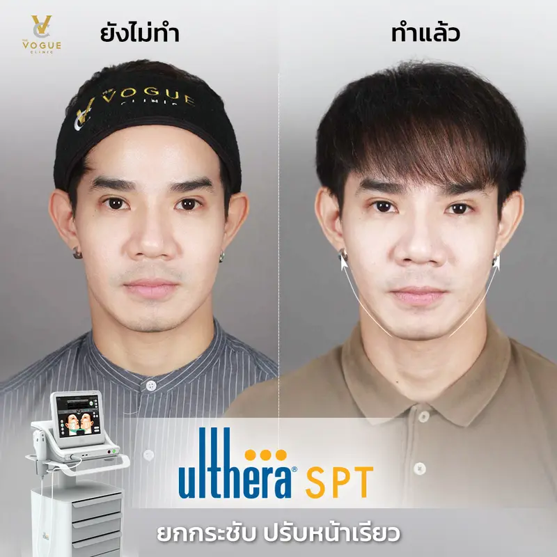 Ulthera