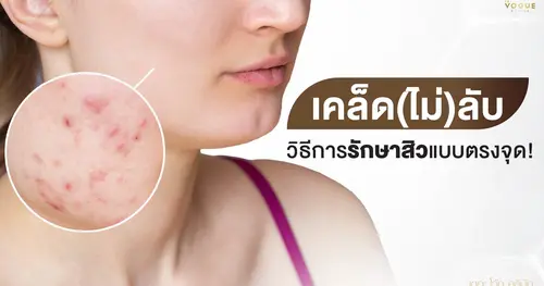 เคล็ด(ไม่)ลับ วิธีการรักษาสิวแบบตรงจุด!