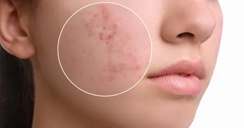 รักษาหลุมสิว(Atrophic Scars) อย่างไรให้หน้าใสเรียบเนียน