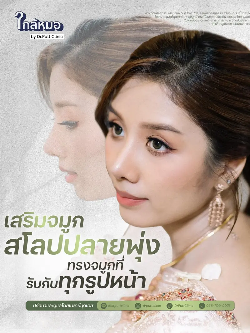 Nose surgery 