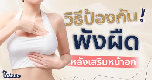 ไม่อยากเป็นพังผืดหลังเสริมหน้าอก ป้องกันอย่างไรดี ?